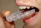 Zahnbleichmittel können mit Hilfe von individuell angepassten
								Schienen auf die Zähne aufgetragen werden