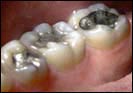 Amalgames dentaires 